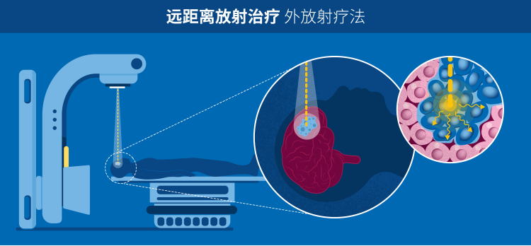 radiotherapy_v3_teletherapy.png